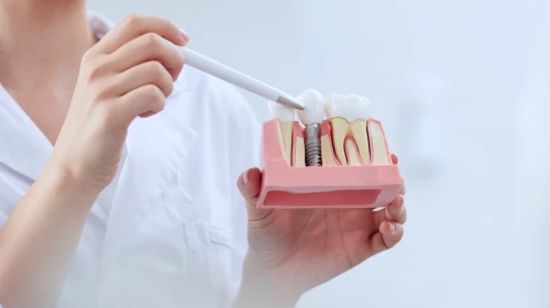 Implante dentário unitário